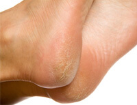 condition-foot_corns_calluses-1