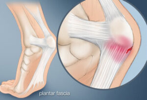 plantar